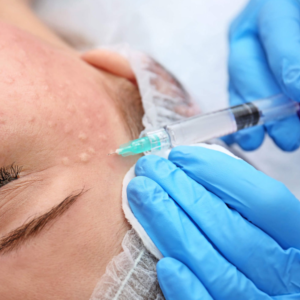AIGUILLES DE MÉSOTHÉRAPIE ET MICRO INJECTIONS 32G 4MM